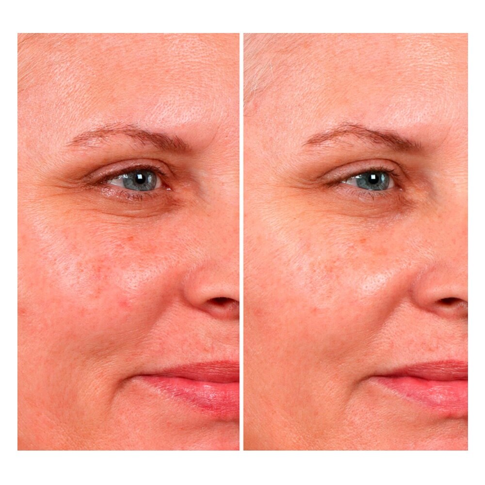 HELLO RESULTS BISPHASE PEEL (PEELING HIDRATANTE PARA ROSTRO)